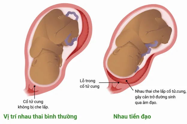 TÌM HIỂU VỀ NHAU TIỀN ĐẠO