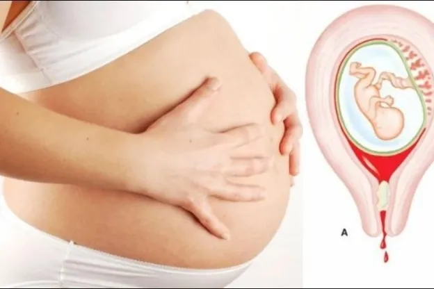 CHẢY MÁU ÂM ĐẠO KHI MANG THAI