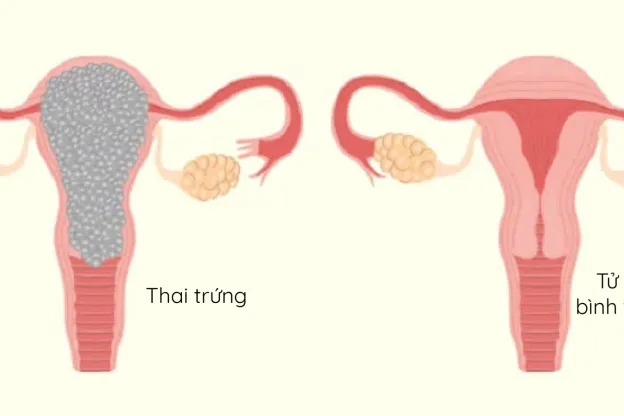 THAI TRỨNG: DẤU HIỆU NHẬN BIẾT VÀ CÁCH ĐIỀU TRỊ