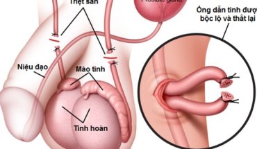 THẮT ỐNG DẪN TINH - NHỮNG THẮC MẮC THƯỜNG GẶP