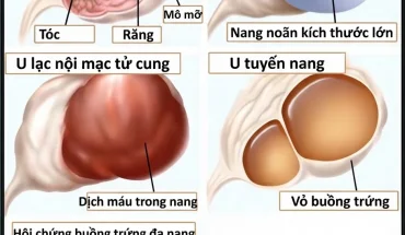 U NANG BUỒNG TRỨNG