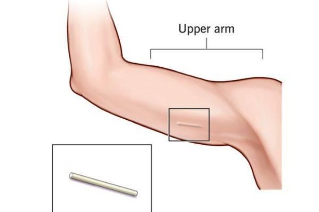 QUE CẤY TRÁNH THAI: NHỮNG THẮC MẮC THƯỜNG GẶP