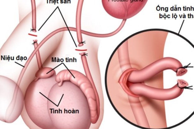 THẮT ỐNG DẪN TINH - NHỮNG THẮC MẮC THƯỜNG GẶP