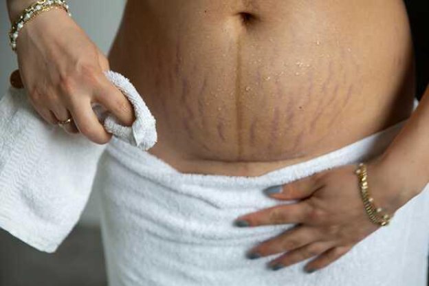 HƯỚNG DẪN CHĂM SÓC VẾT MỔ SAU MỔ LẤY THAI