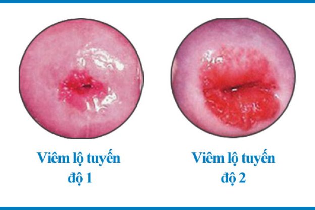 PHÁT HIỆN LỘ TUYẾN CỔ TỬ CUNG: CÓ NHẤT THIẾT PHẢI ĐỐT?