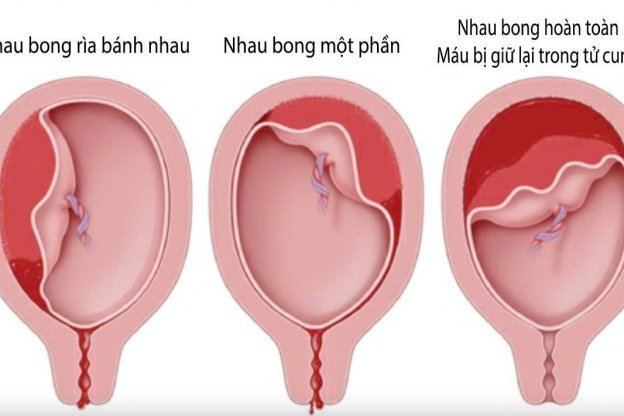 NHAU BONG NON – BIẾN CHỨNG THAI KỲ NGUY HIỂM MẸ BẦU CẦN NHẬN BIẾT SỚM