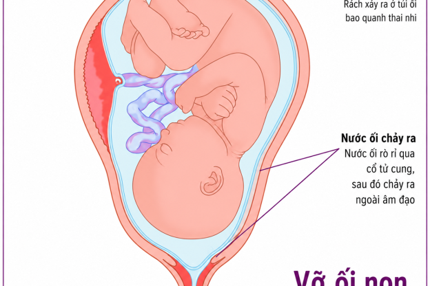 ỐI VỠ NON VÀ CÁCH XỬ TRÍ