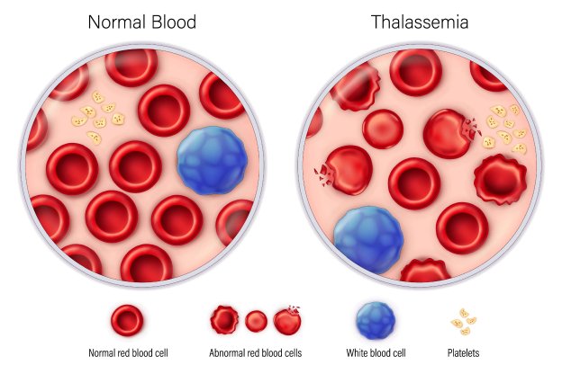 THALASSEMIA – BỆNH DI TRUYỀN GEN LẶN MÀ CÁC CẶP VỢ CHỒNG CHUẨN BỊ MANG THAI NÊN TẦM SOÁT