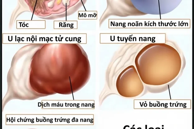 U NANG BUỒNG TRỨNG